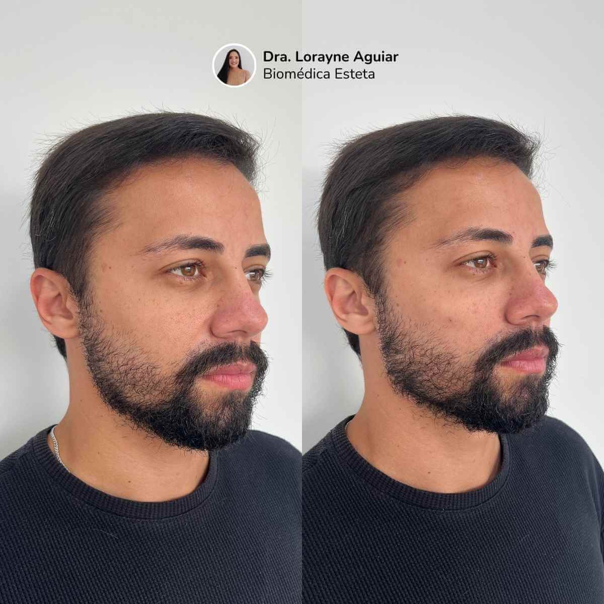 Harmonização Facial