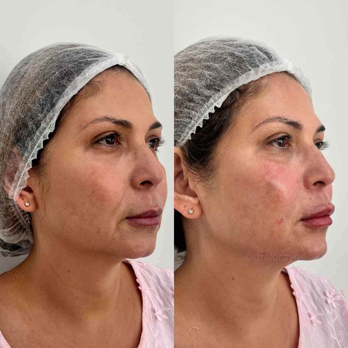 Harmonização Facial