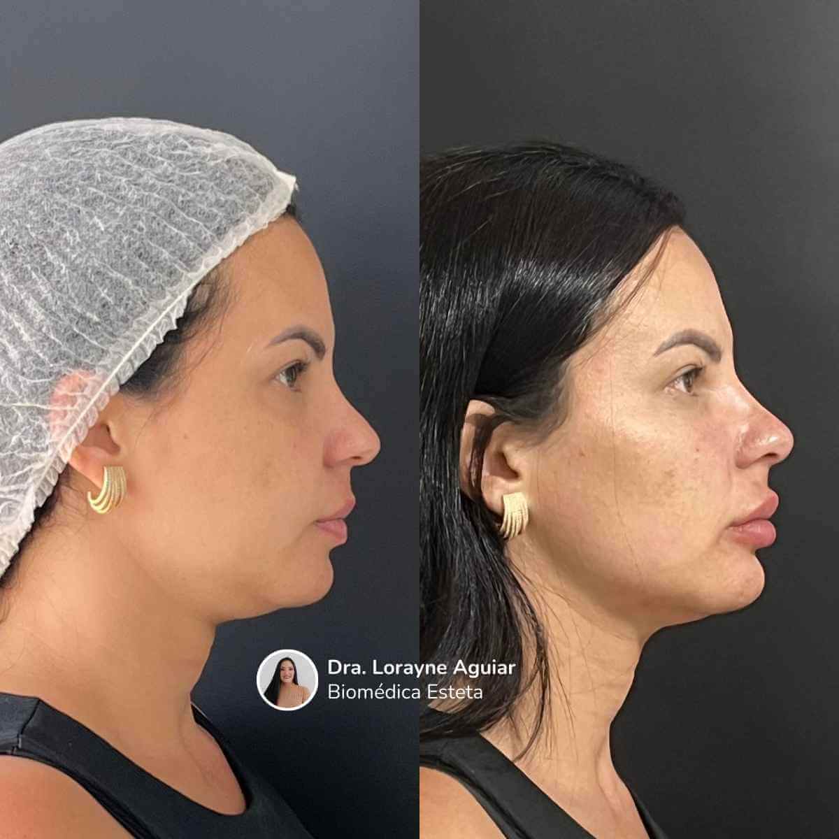 Harmonização Facial
