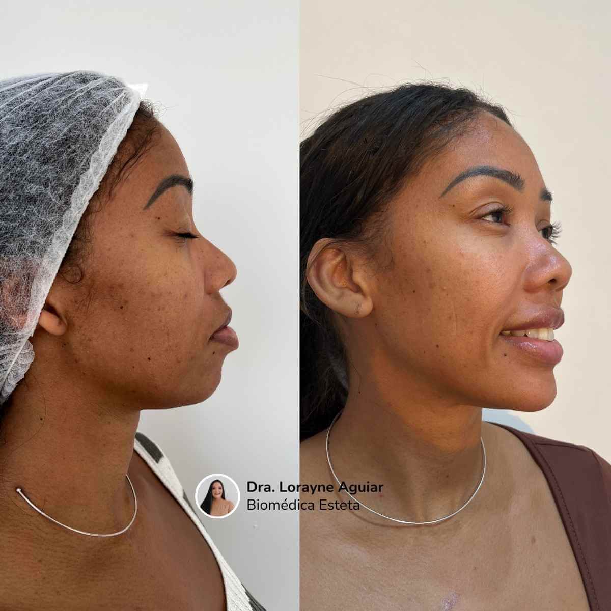 Harmonização Facial