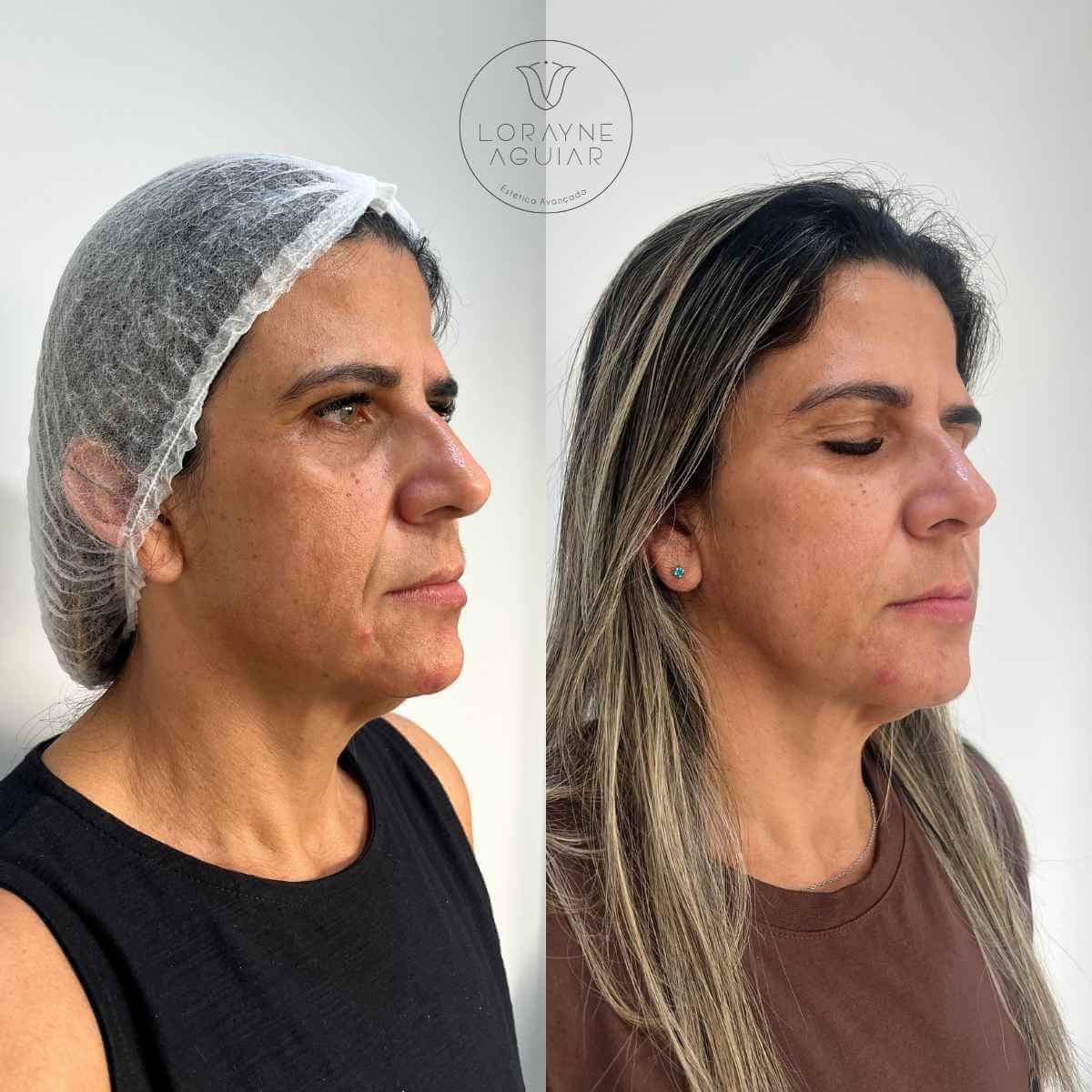 Harmonização Facial