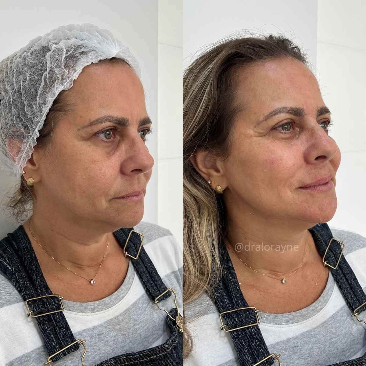 Harmonização Facial