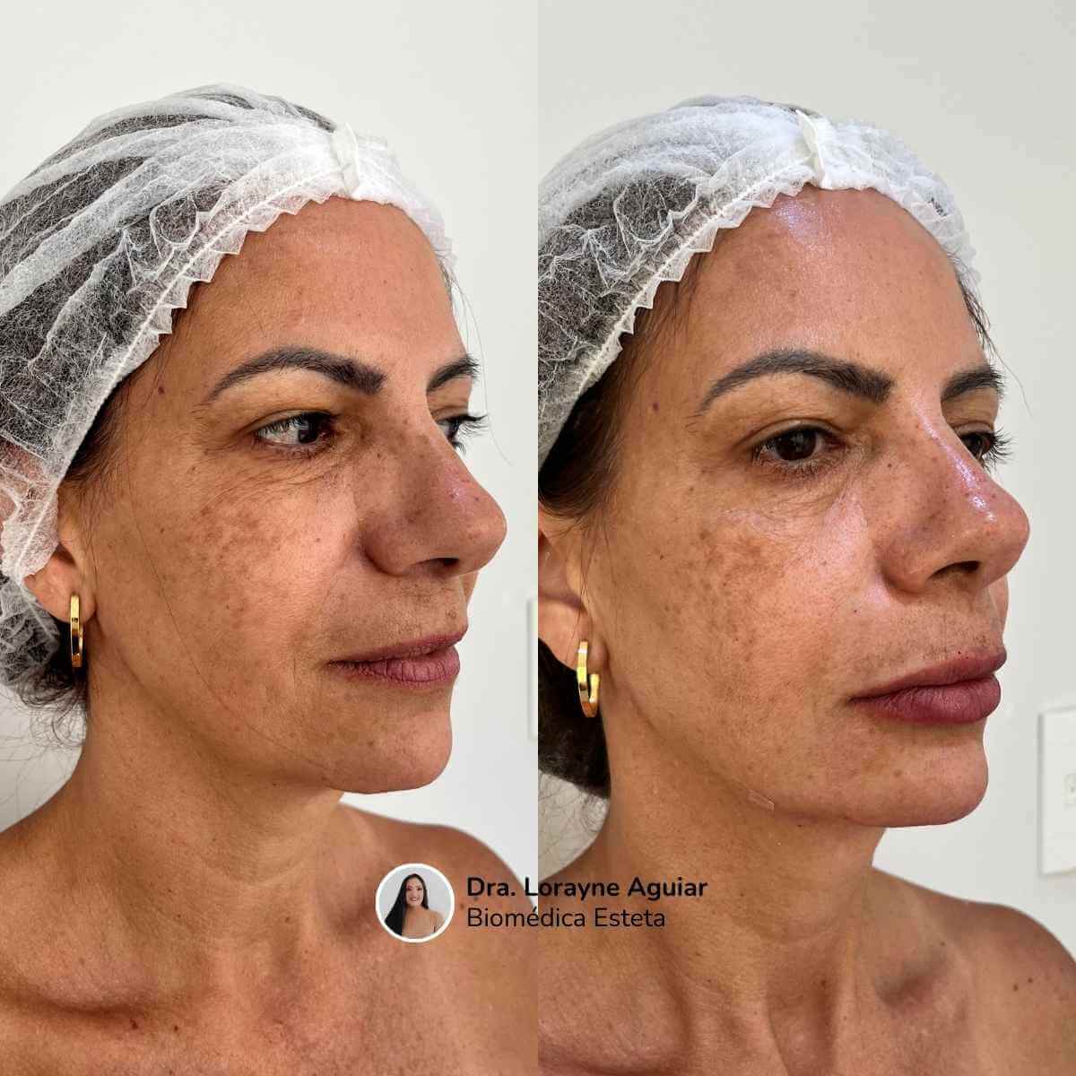 Harmonização Facial