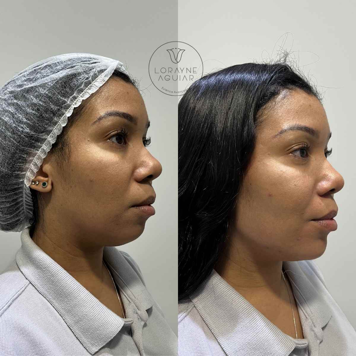 Harmonização Facial